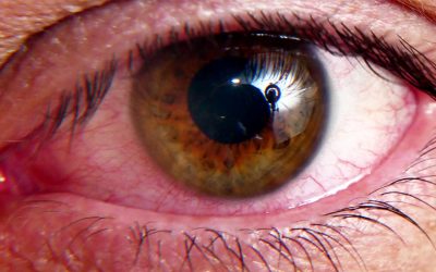 Eye Strain Relief: Relief Techniques