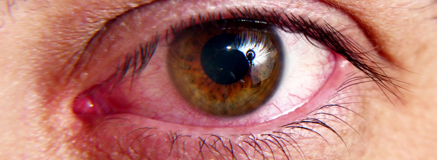 causes of digital eye strain