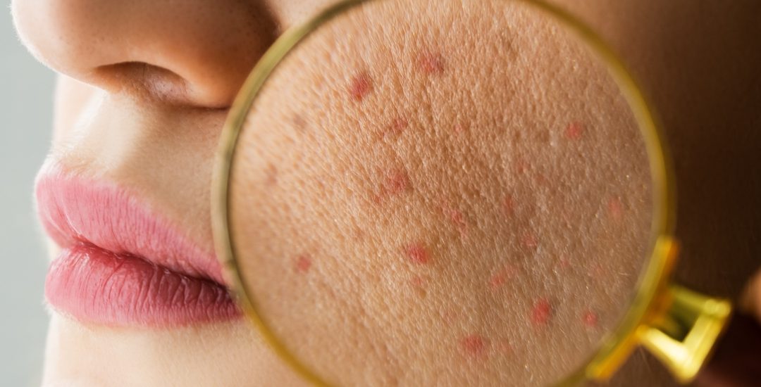 Acne Treatment: Effective Treatments