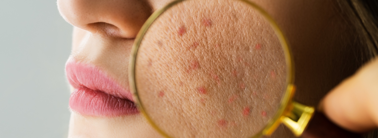 home remedies for acne