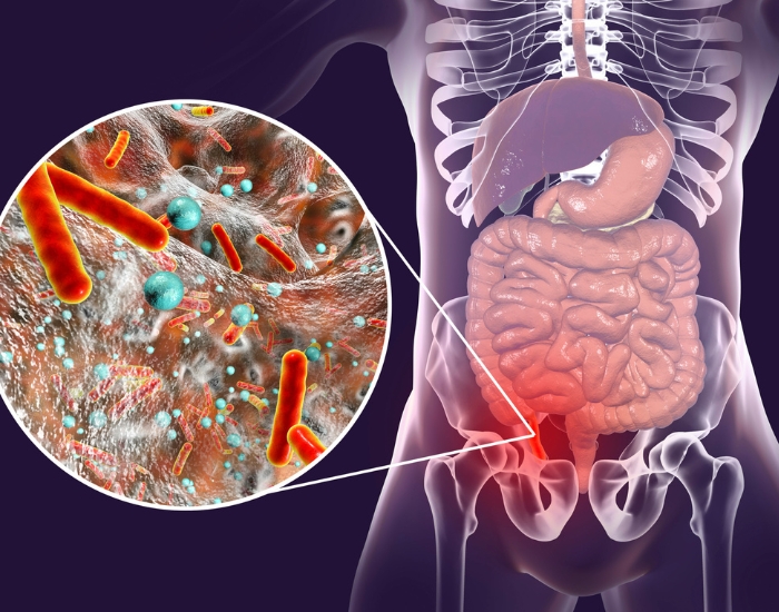 Signs and Symptoms of Appendix Bursting | Sugar Land Guide