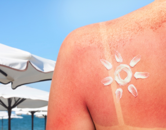 Sun Poisoning Rash: Signs, Treatment, and Prevention Tips