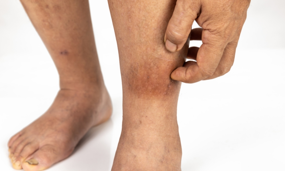 Cellulitis skin infection comparison
