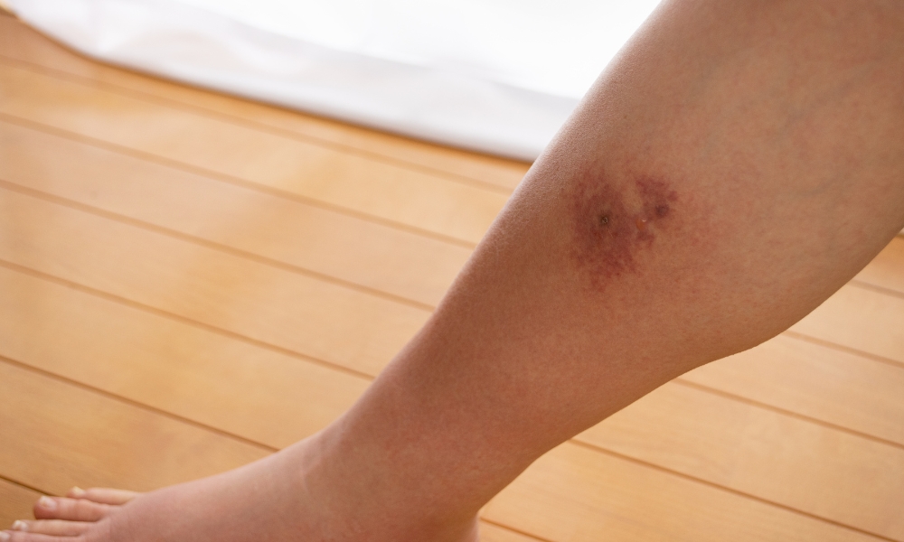 Early cellulitis infection on skin